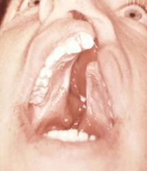 Больной с синдромом Патау (незаращение нёба, верхней губы и альвеолярного отростка)